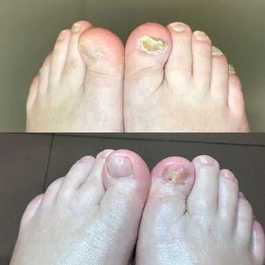 Experiência no uso de Creme de Promicil Barnabas de Israel, foto antes e depois