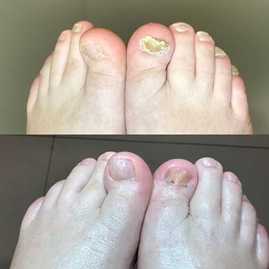 Experiência no uso de Promicil Barnavay de Israel, foto antes e depois
