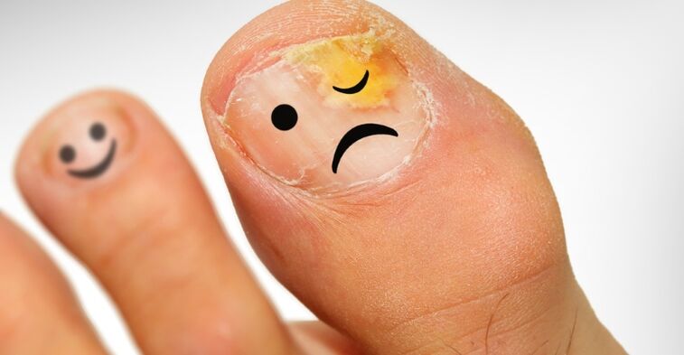 Como reconhecer o fungo das unhas