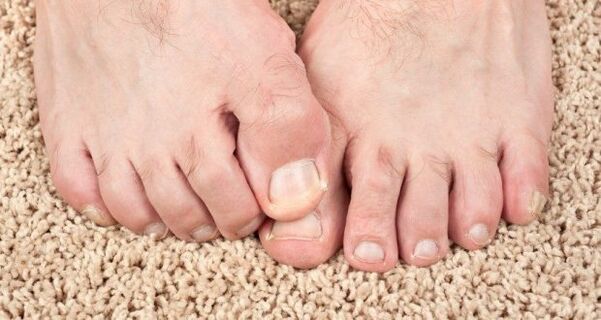 Sintomas de fungo das unhas