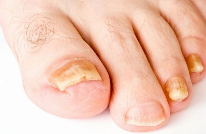 O fungo no polegar da perna