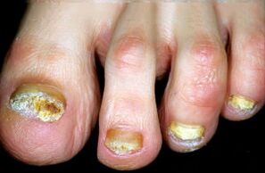 Caracterização da doença