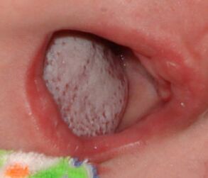 Localização da doença com um fungo