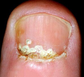 Sintomas e sinais da doença