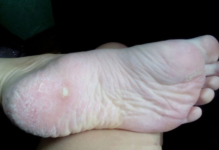 Tratamento do fungo com um laser