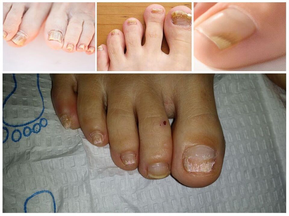 Doenças fúngicas das placas ungueais