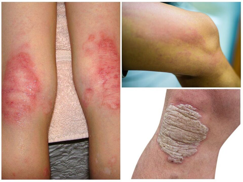 Infecções fúngicas dos joelhos