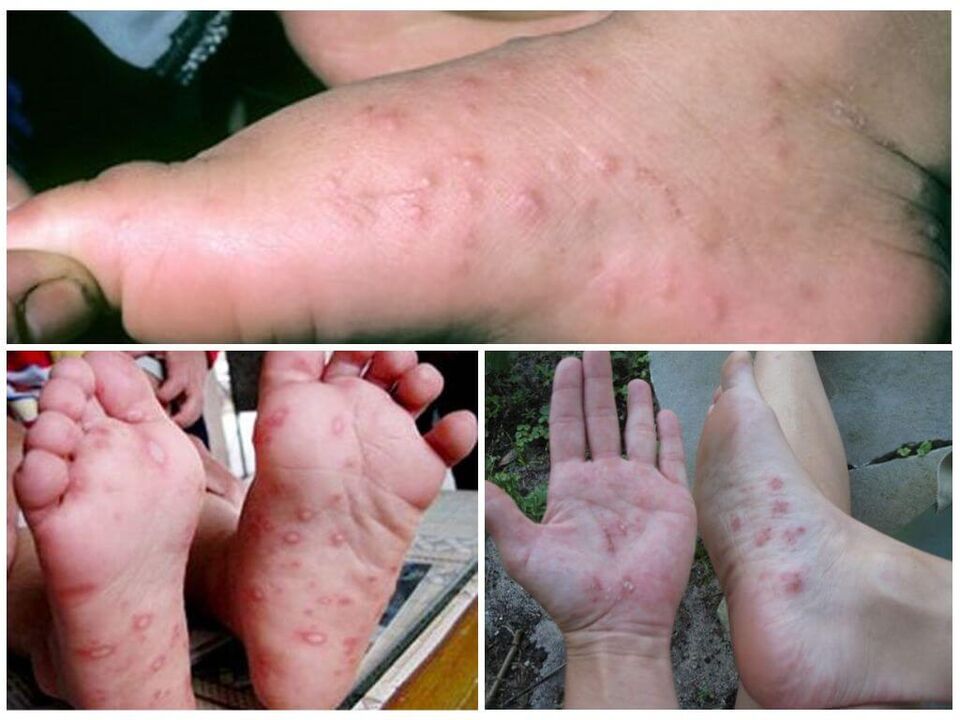 Lesões hiperceratóticas dos pés