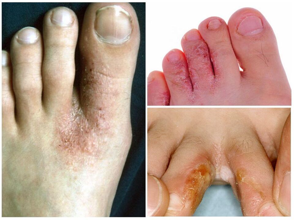 Micose interdigital