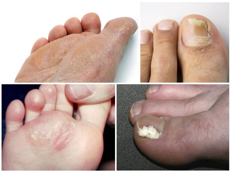 O estágio inicial do fungo nos pés