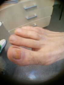 estágio inicial do fungo nas unhas do dedão do pé