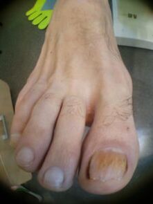 fungo nas unhas do dedão do pé