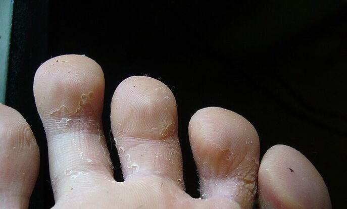 estágio inicial do fungo