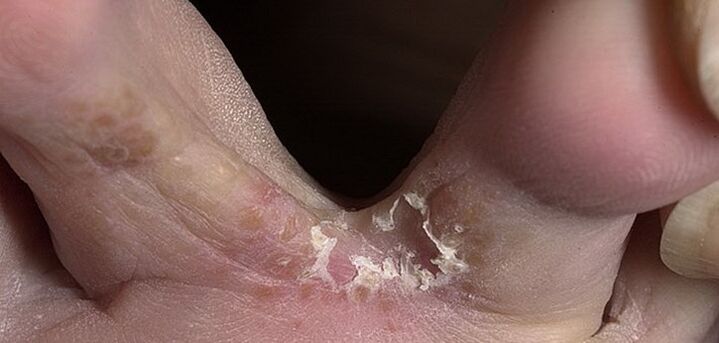 fungo entre os dedos dos pés