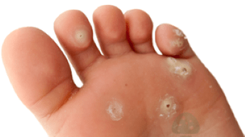 segundo estágio da infecção fúngica