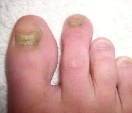 unhas afetadas por fungos antes do tratamento