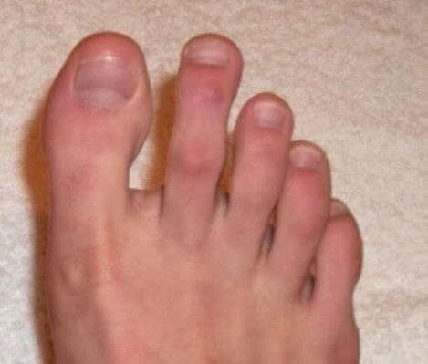 unhas após tratamento a laser para fungos