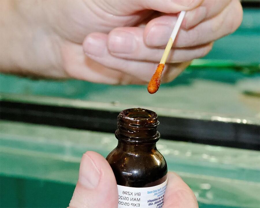 Aplicar uma mistura de iodo e suco de celidônia nas unhas dos pés eliminará fungos
