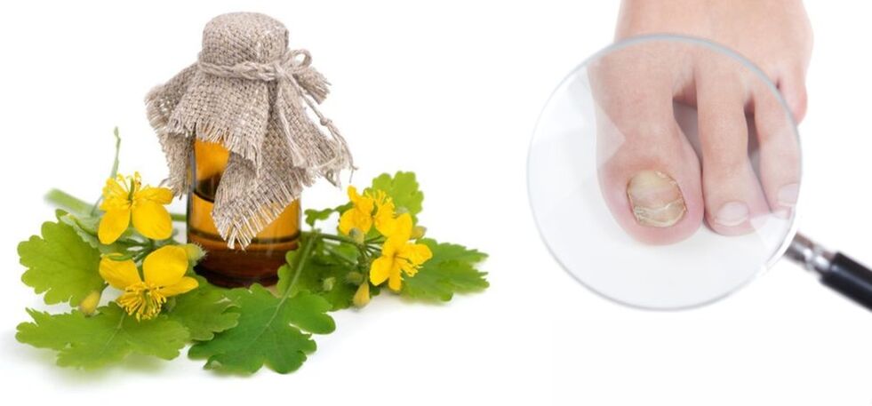 Celandine para fungo nas unhas