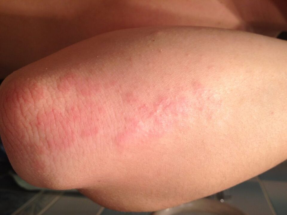 Uma reação alérgica na forma de erupção cutânea na pele do cotovelo após a aplicação de uma gota de suco de celidônia